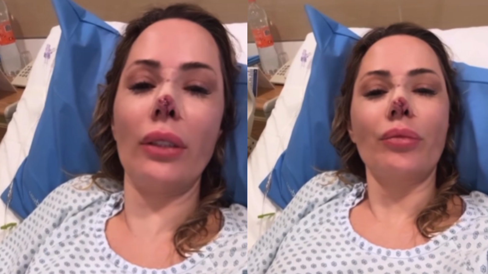 Influenciadora é atacada por cachorro e faz cirurgia: “Reconstruí o nariz“