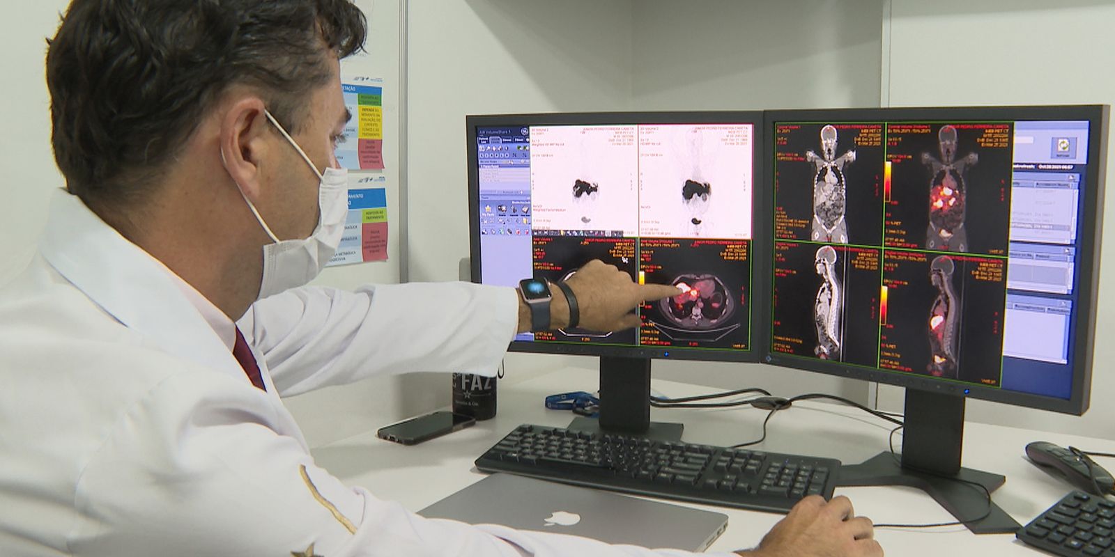Rastreamento de câncer de intestino identifica lesões em 231 pacientes